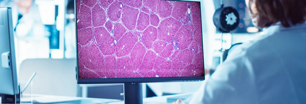 First artificial intelligence tool to help analyse liver biopsy scans